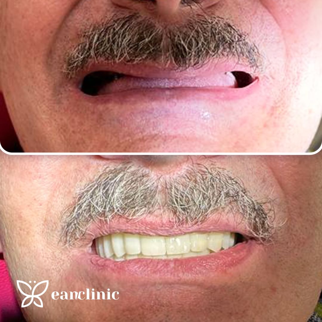 Zâmbet cu dinți aliniați, detaliu facial