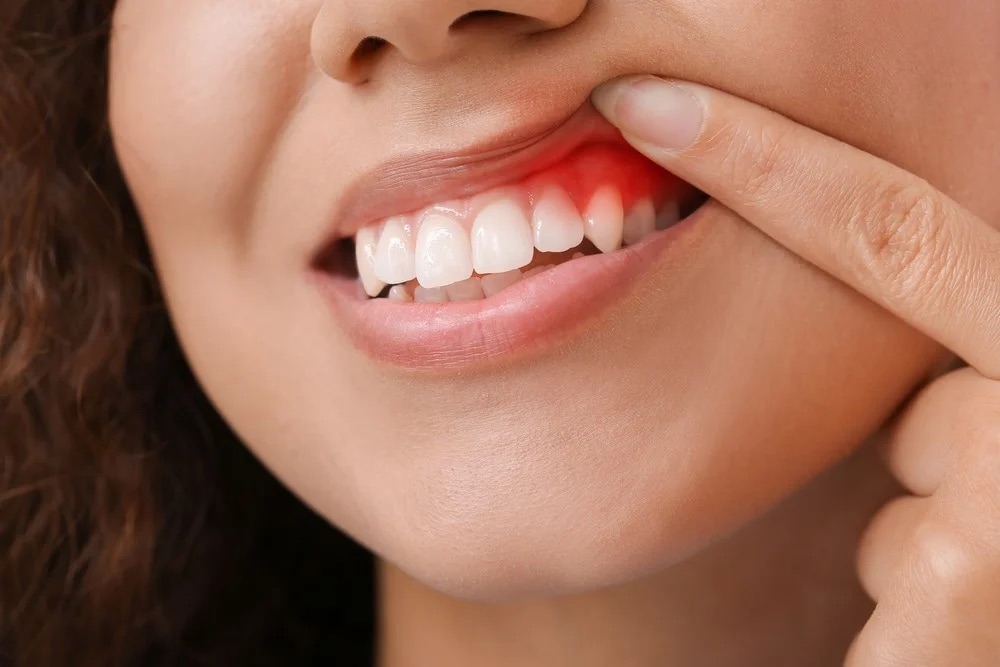 Tratament gingivită EAN Clinic
