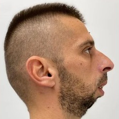 Profil pacient înainte de chirurgie ortognatică EAN Clinic