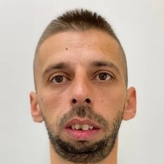 Frontal pacient înainte de chirurgie ortognatică EAN Clinic