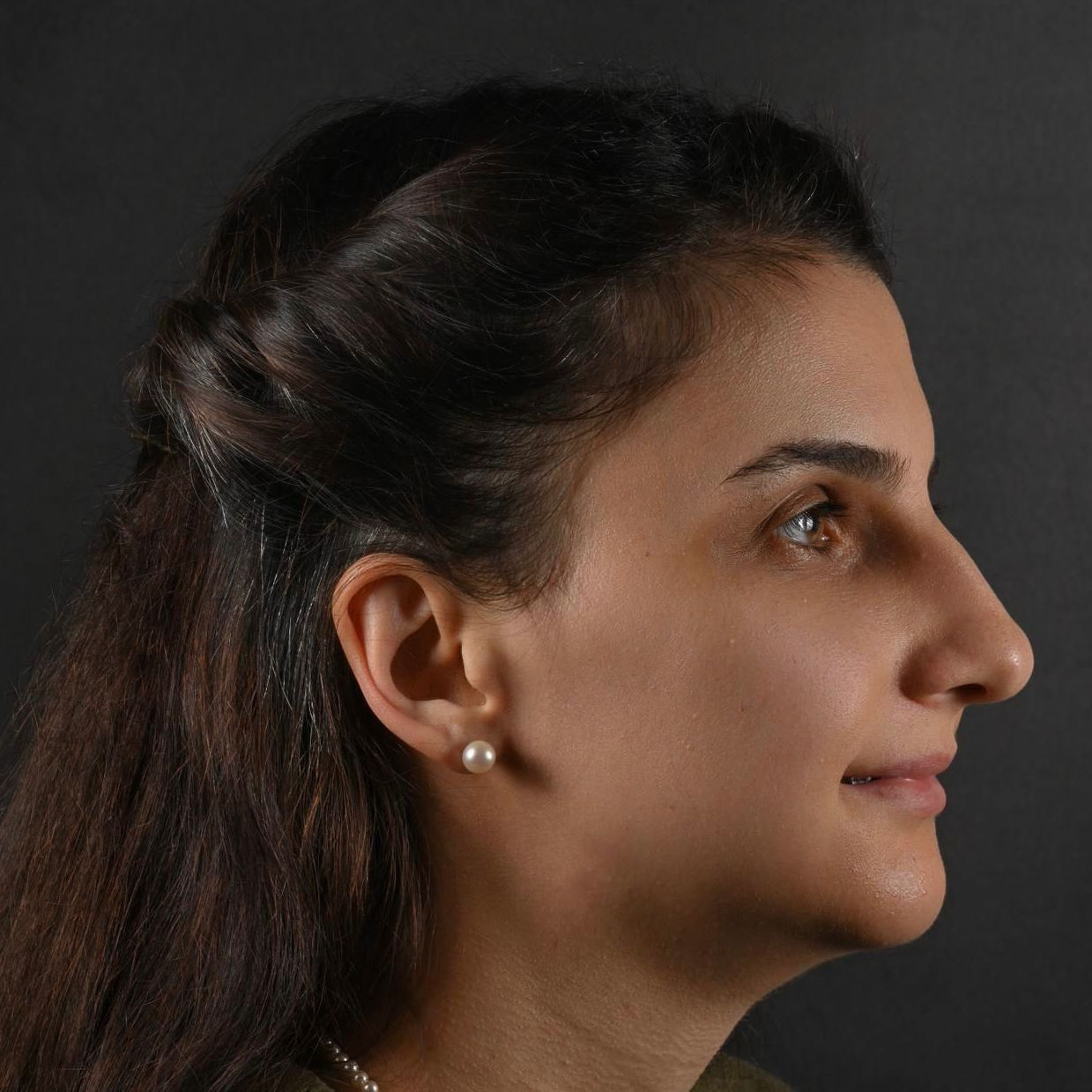 Profil pacient după chirurgie ortognatică EAN Clinic - caz 2