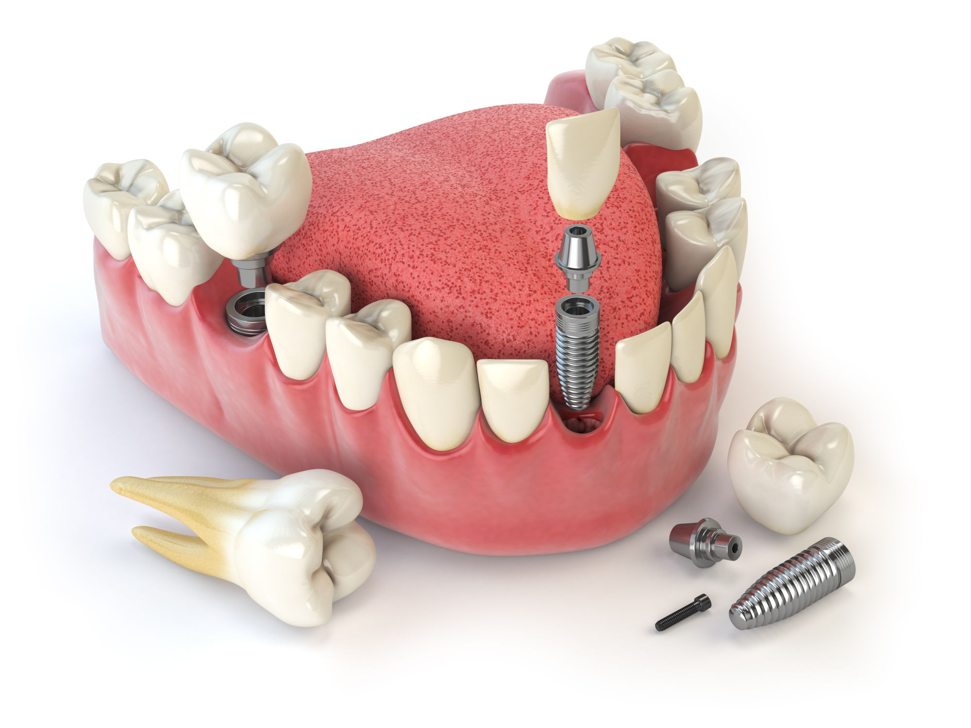 Factori care influențează prețul implantului dentar