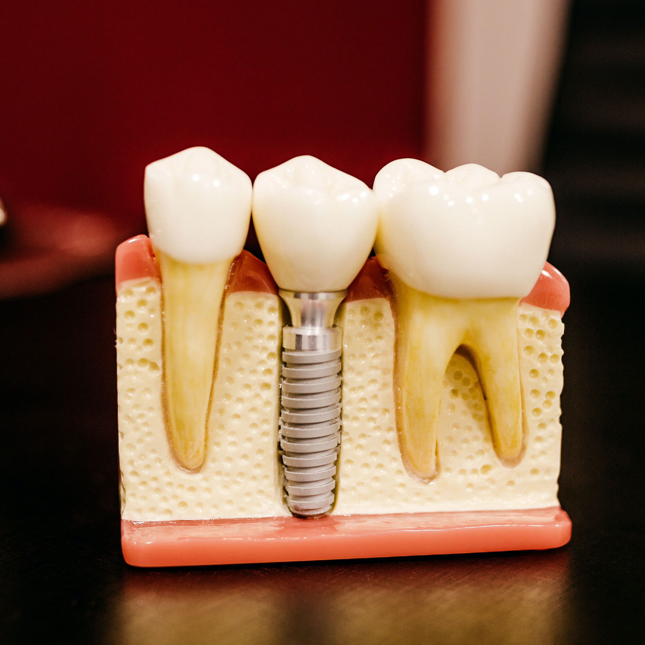 EAN Clinic — implant dentar Iași