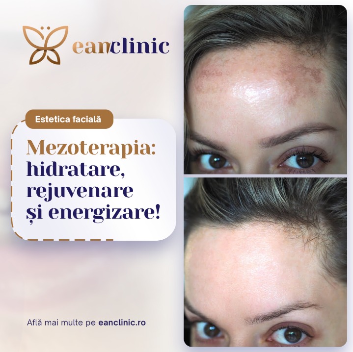 Mezoterapie