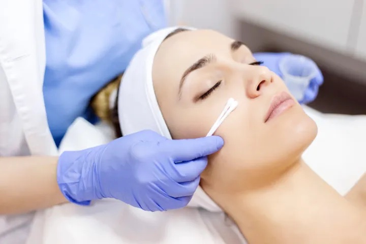 Peeling chimic