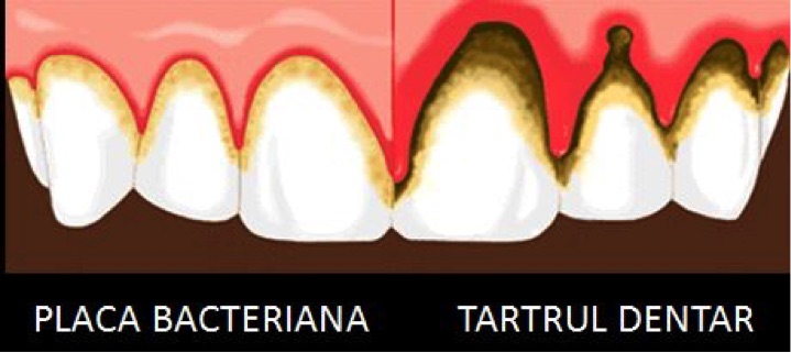 Tratament gingivită și parodontită — EAN Clinic
