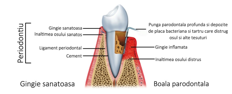 Evoluția bolii parodontale — EAN Clinic