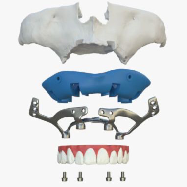 Implant dentar Fast&Fixed — EAN Clinic
