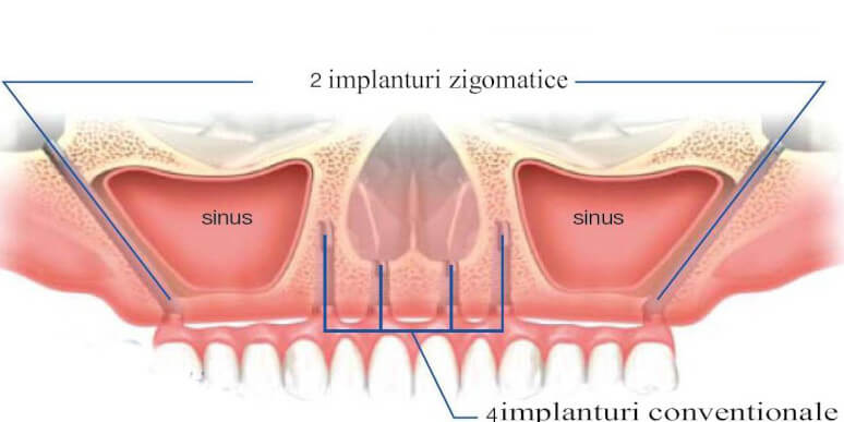 Implant dentar zigomatic și personalizat — EAN Clinic