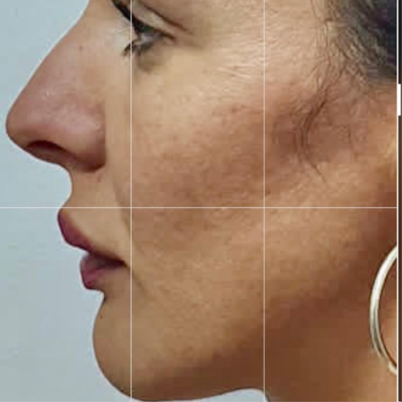 Reechilibrare facială complexă - înainte