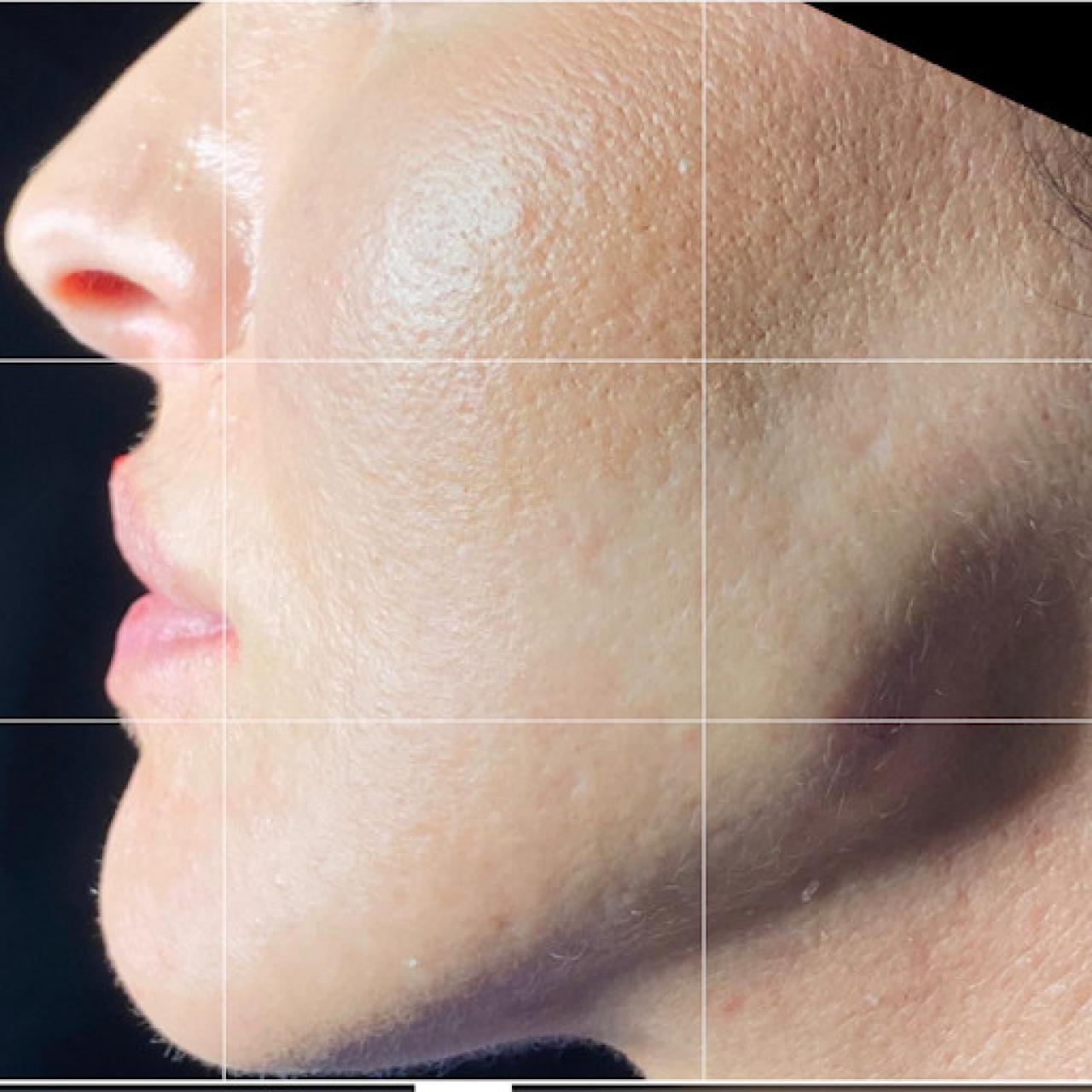 Reechilibrare facială complexă - după