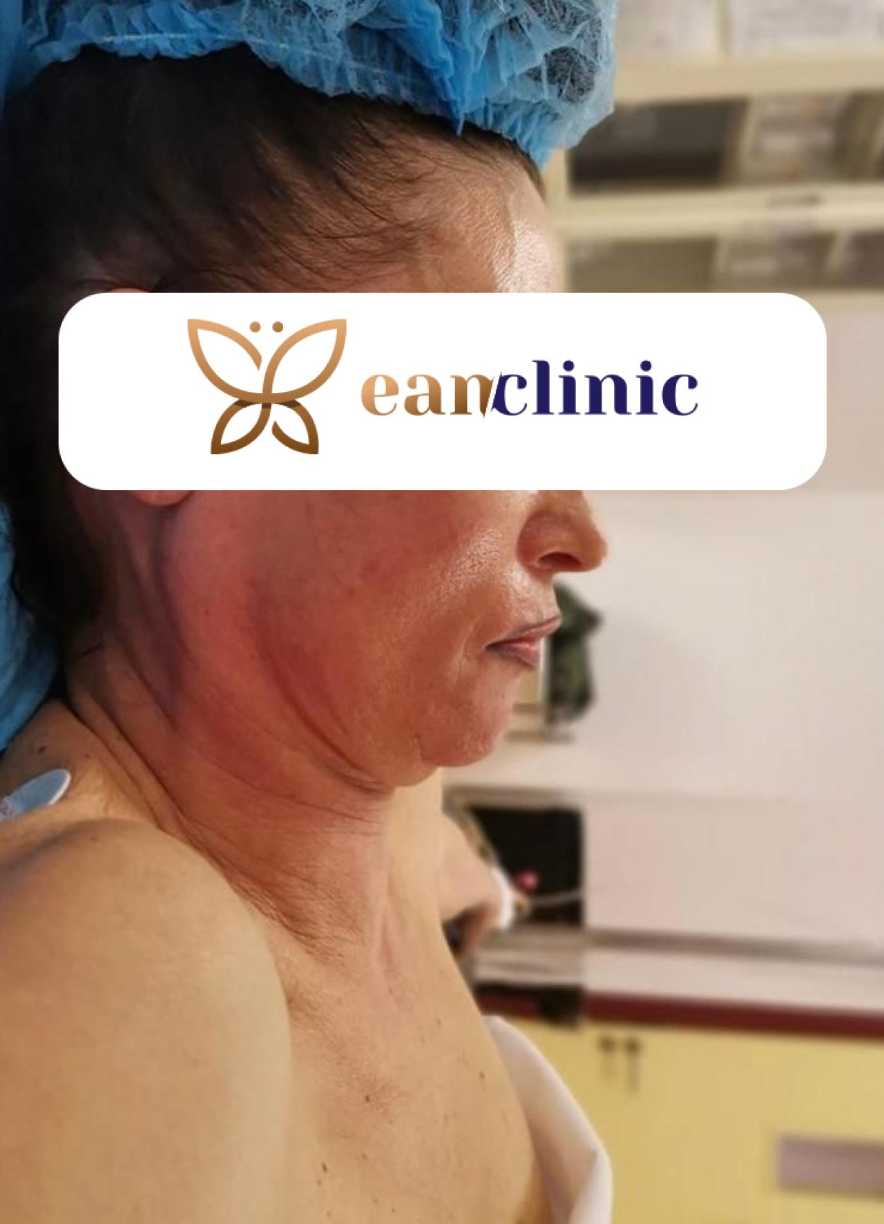 Face neck lifting - înainte