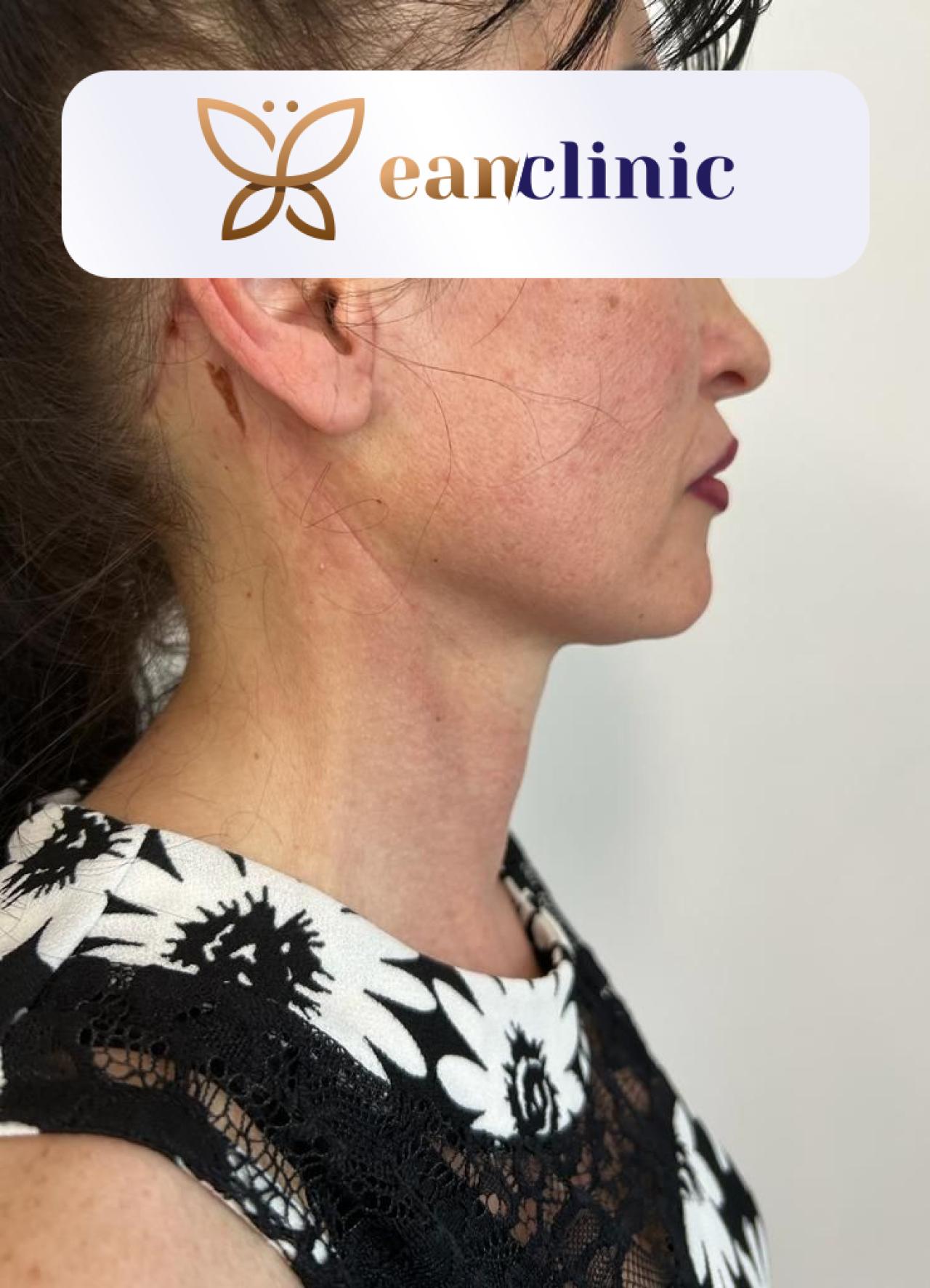 Face neck lifting - după