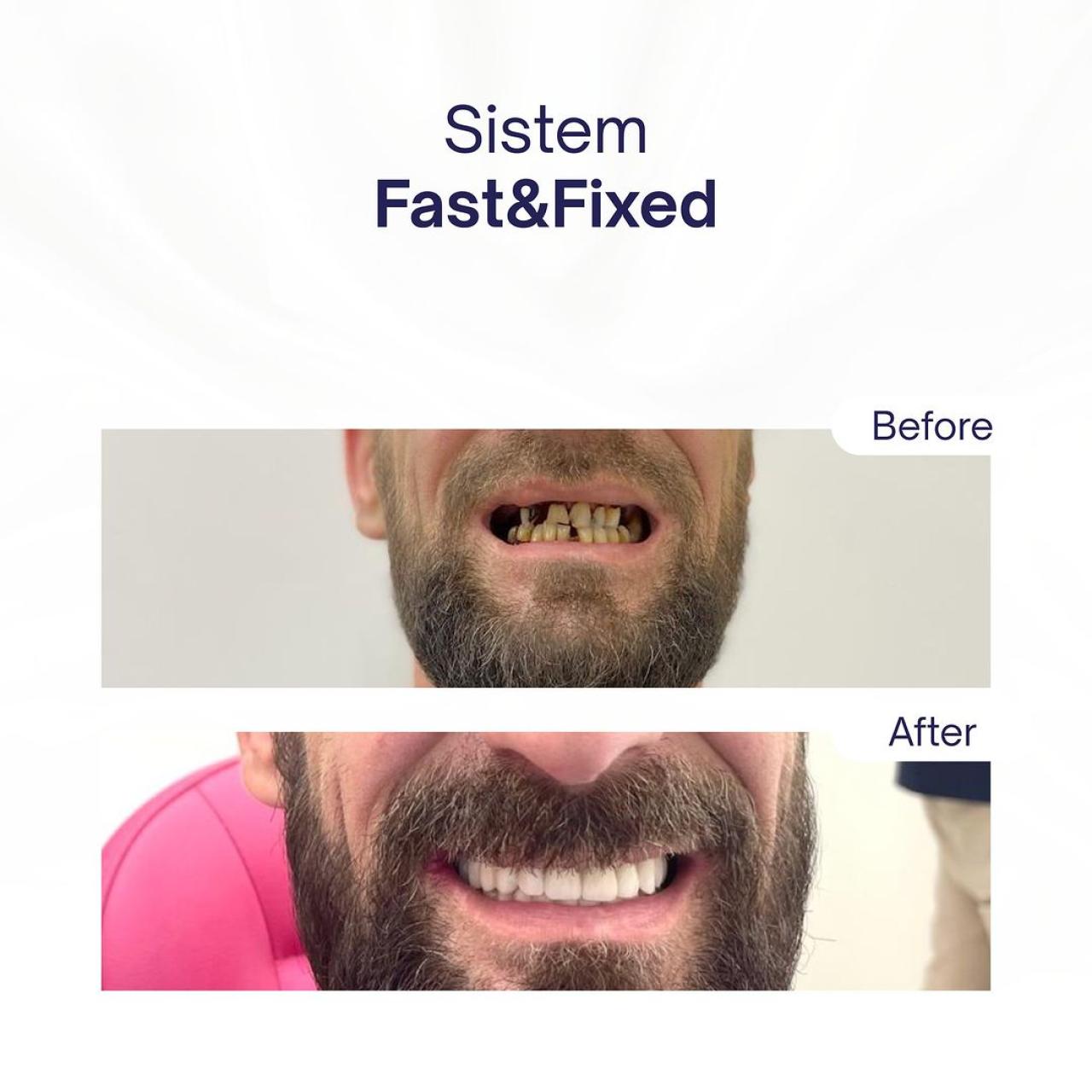 Fast&Fixed - Reabilitare totală