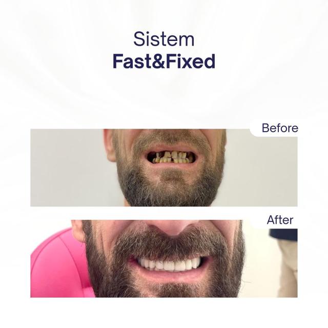 Fast&Fixed - Reabilitare totală