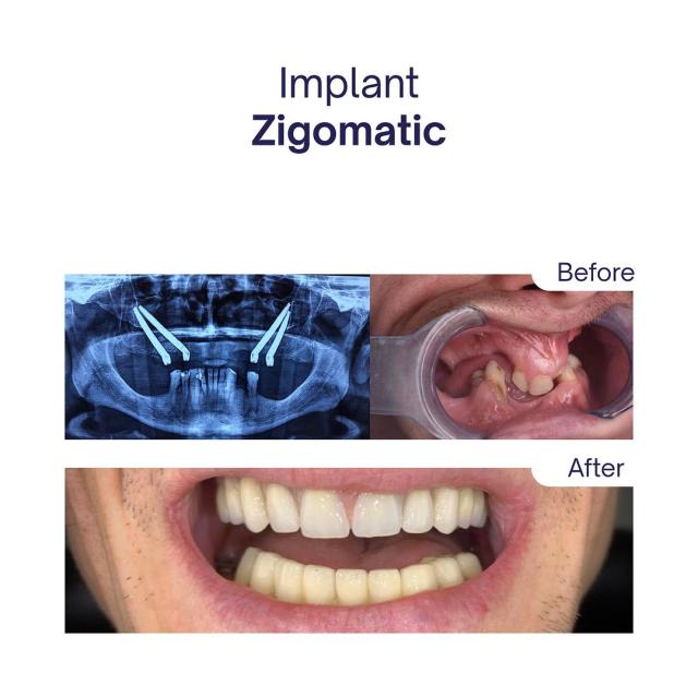 Implant Zigomatic
