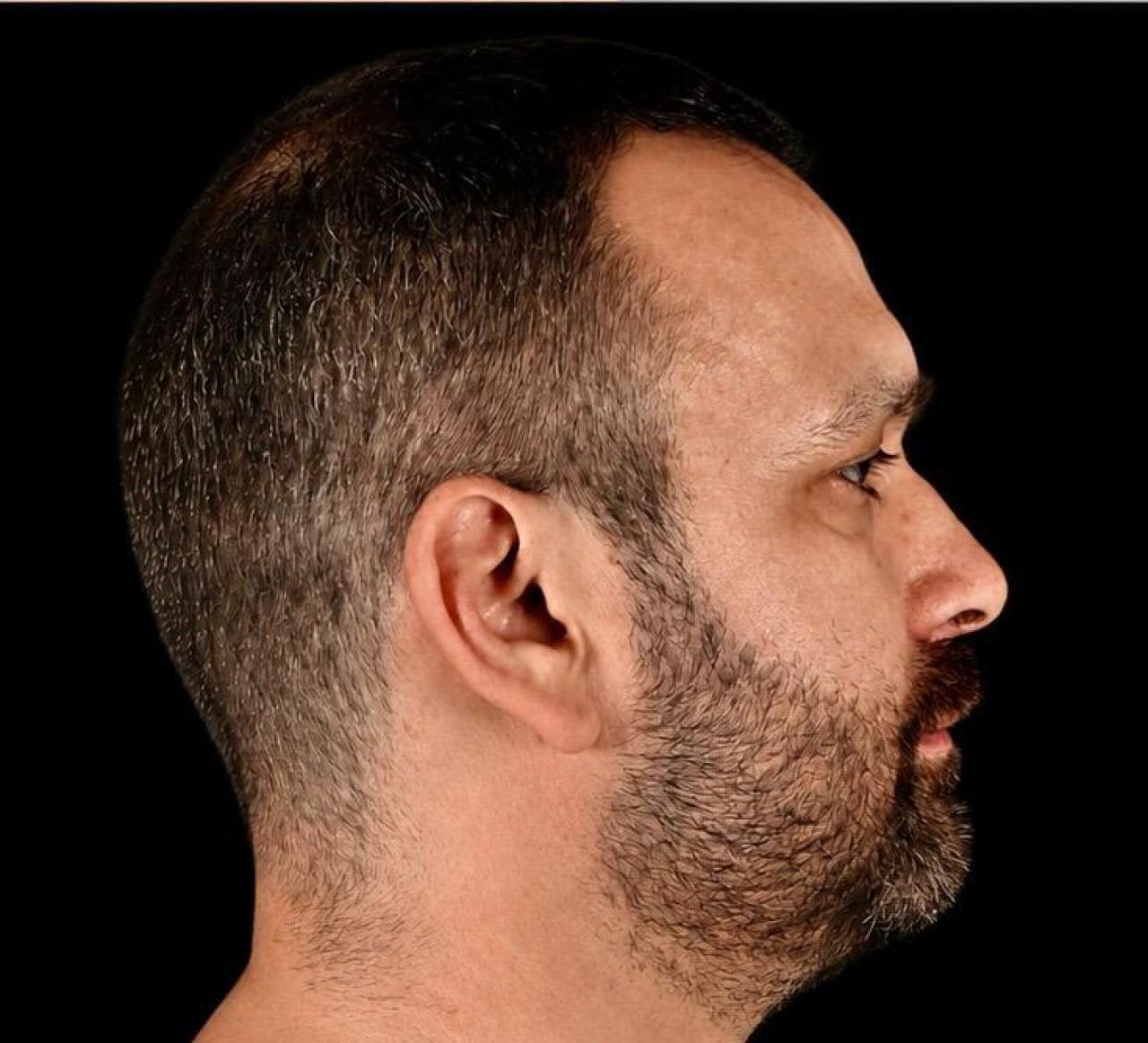 dezechilibru major al armoniei faciale - după