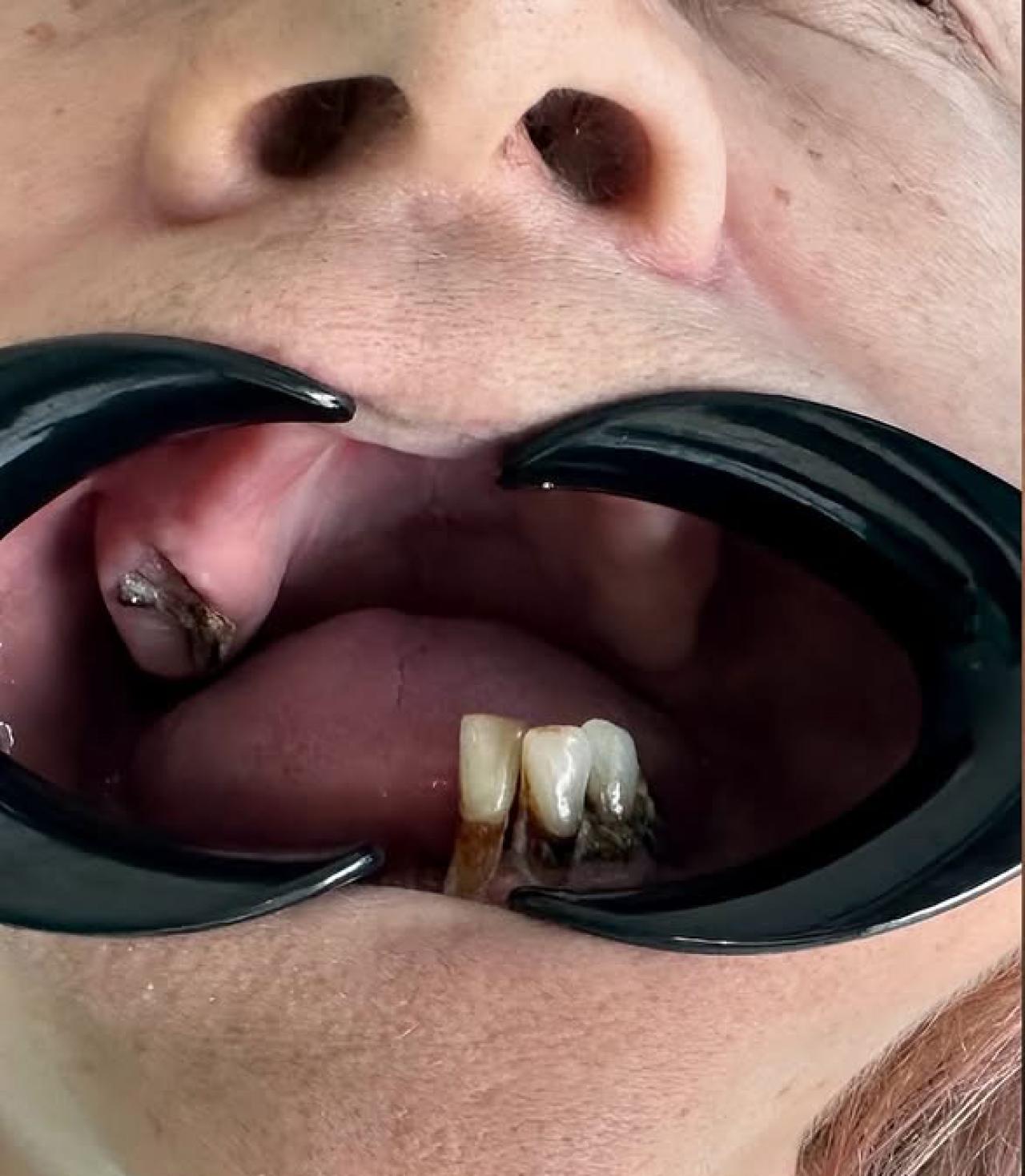 Full Face Recovery cu Implanturi Zigomatice - înainte